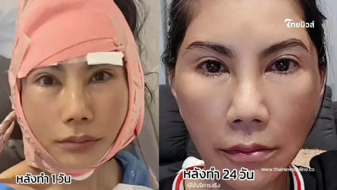 "แก้ว อภิรดี" ศัลยกรรมครบ2เดือน เด็กลงมาก สวยสับจนคนแห่ชมสนั่น