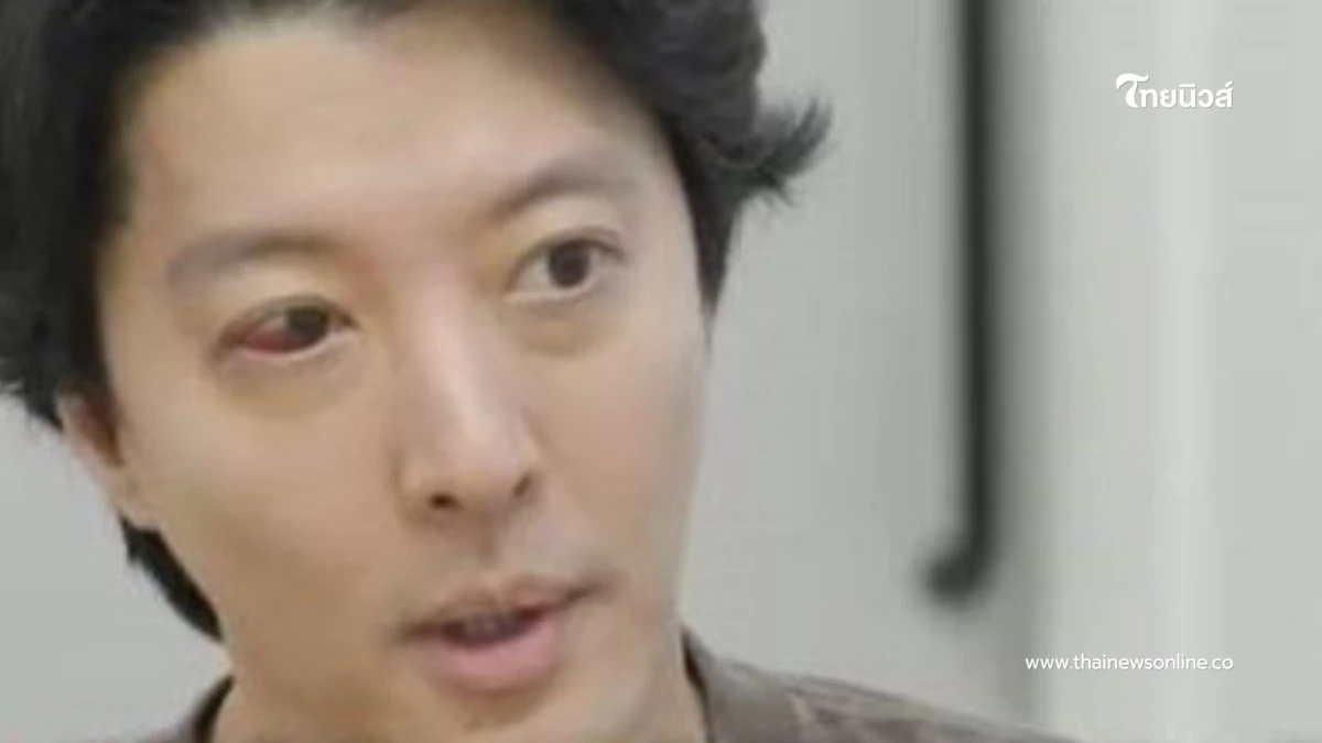 นักแสดงชื่อดัง ป่วยโรคหายาก ตาข้างหนึ่งแดง - เจ็บปวดรุนแรง