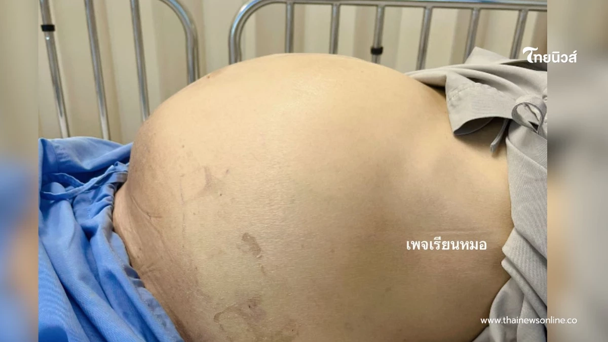 เตือนสายกินดิบ หญิงวัย 60 ท้องมานโต สุดท้ายเป็นมะเร็งท่อน้ำดี