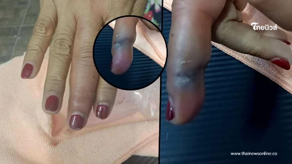 สาวไปหาหมอ ถูกเปลือกกุ้งทิ่มมือ สุดท้ายเกือบเป็นฝันร้าย