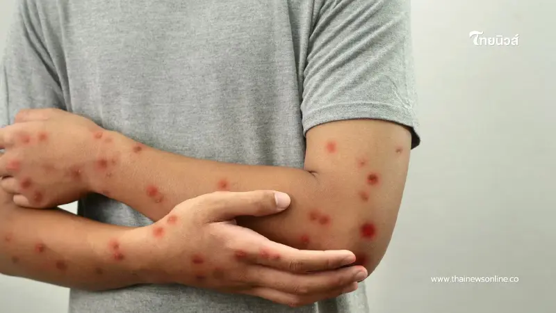 รู้ทัน ป้องกันได้ รับมือฝีดาษวานร หลังพบผู้ป่วยรายใหม่ในไทย