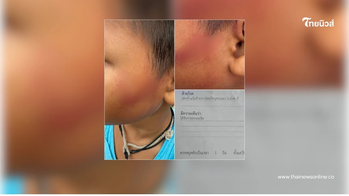 แม่สุดช้ำ ขอเพียงอย่างเดียว หลังครูโหดตีลูก 7 ขวบ จนเป็นแผลในใจ