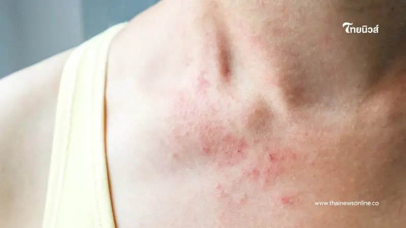 คนออกกำลังกายระวัง! แพ้เหงื่อตัวเอง ผื่นแดงคันอาจเกิดได้ทุกวัย