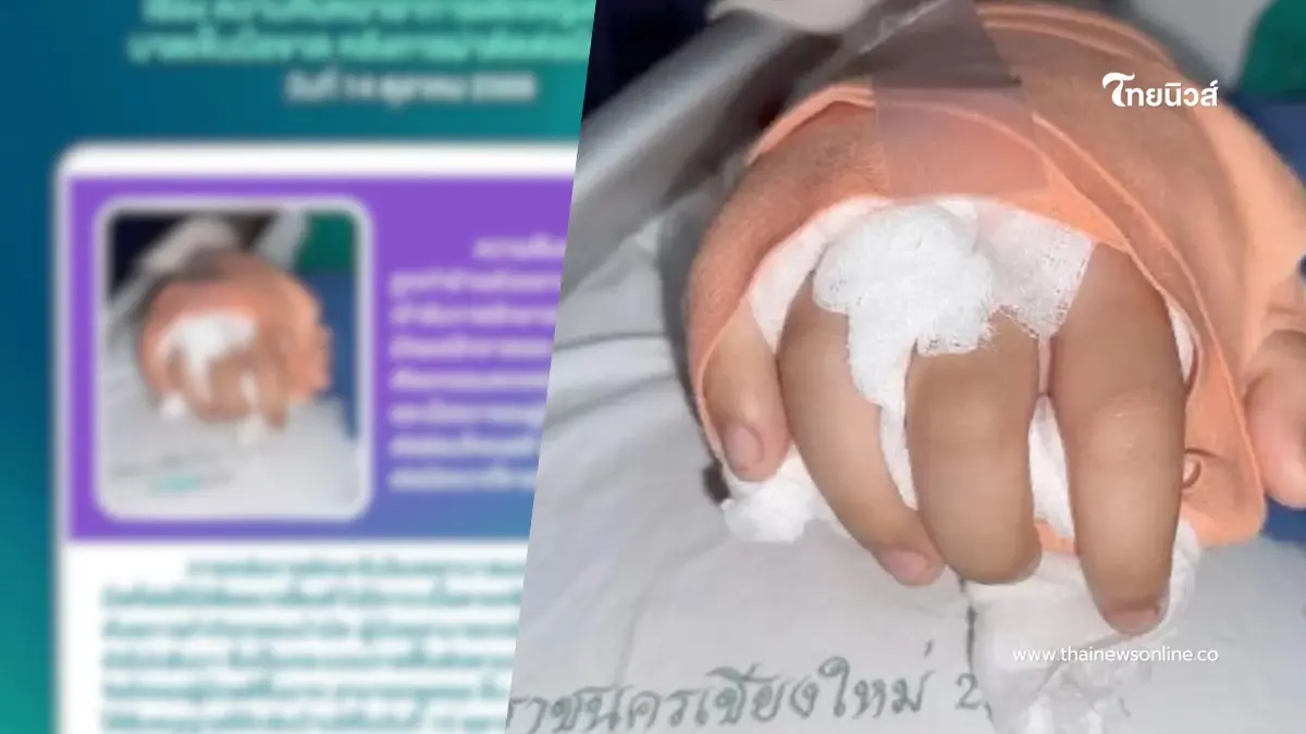 แพทย์ มช. อัปเดตเคสเด็กหญิงวัย 14 ถูกฟันข้อมือขาด มีข่าวดี
