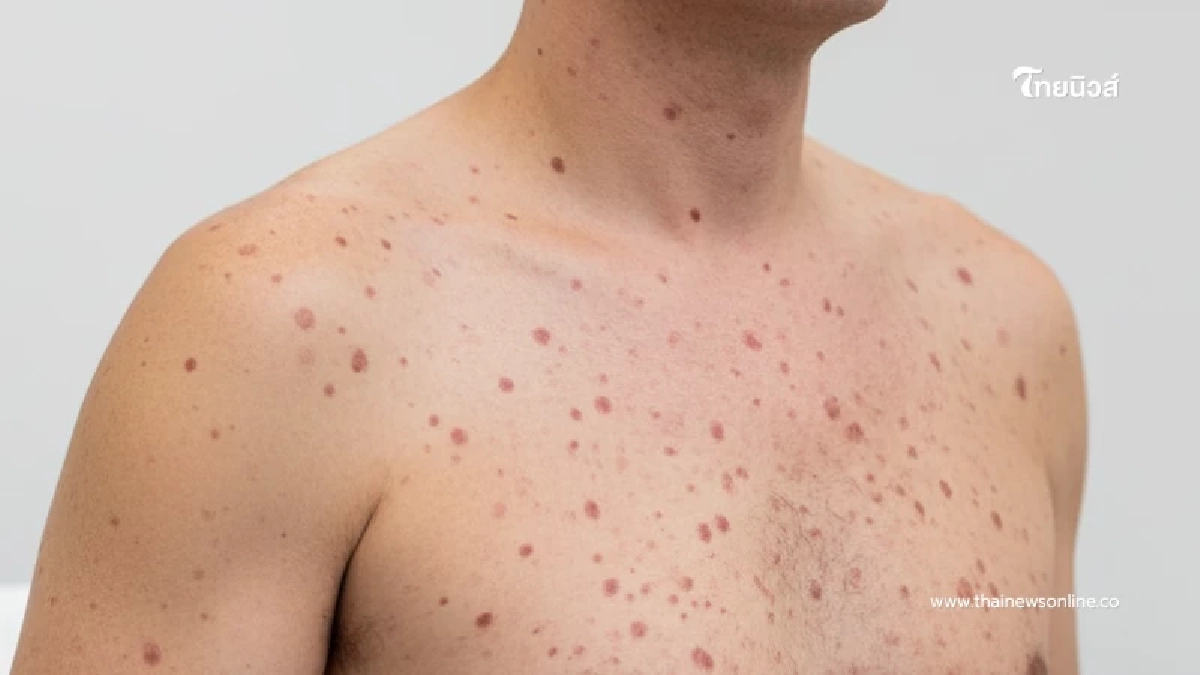 หนุ่มยังไม่เคยจ้ำจี้ ตรวจพบซิฟิลิส พอรู้ว่าติดยังไงบอกเลยซวย