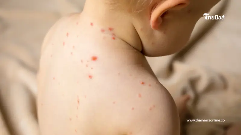 ระวังโรคหัด เชียงรายชายแดนเสี่ยงสูง ปี 68 ป่วยสะสมเกือบ 2,000