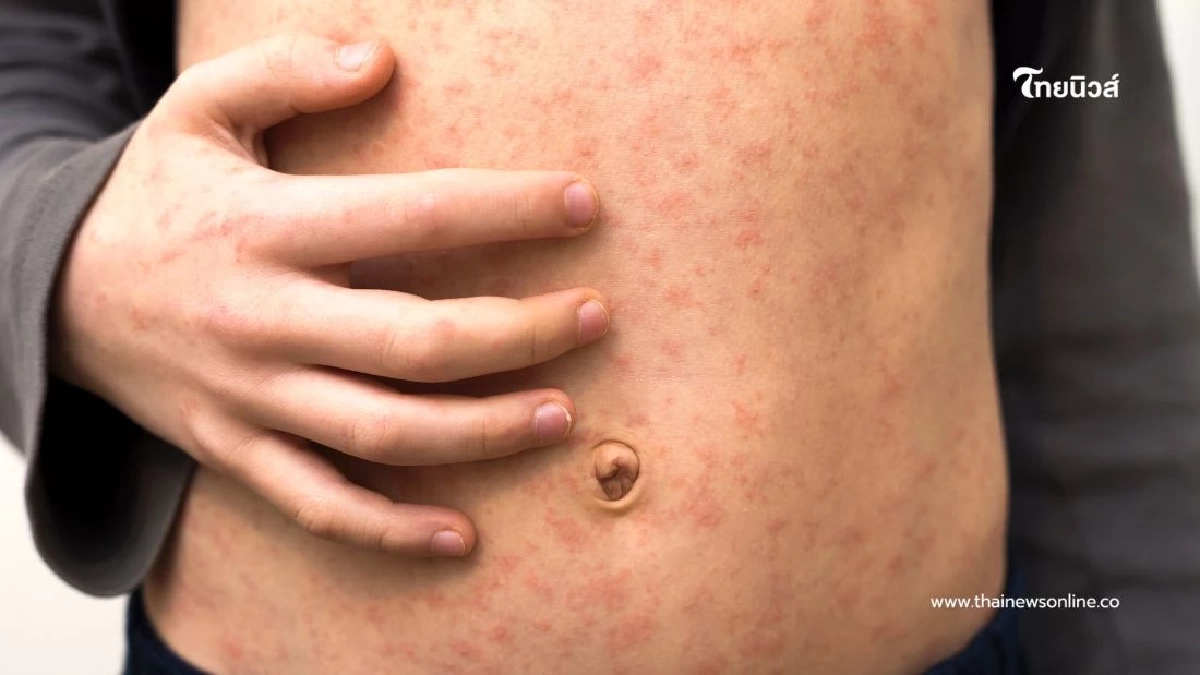 จับตา โรคหัดลาม ระบาดหนักชายแดน กลุ่มเสี่ยงต้องรีบฉีดวัคซีน ก่อนลุกลาม จับตา โรคหัดลาม ระบาดหนักชายแดน กลุ่มเสี่ยงต้องรีบฉีดวัคซีน ก่อนลุกลาม