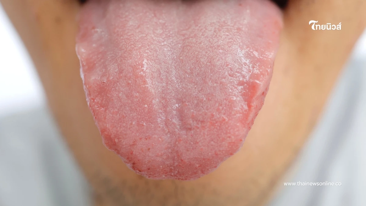 ลิ้นบอกสุขภาพ เช็กได้ว่าร่างกายกำลังส่งสัญญาณเตือนอะไรหรือไม่ ลิ้นบอกสุขภาพ เช็กได้ว่าร่างกายกำลังส่งสัญญาณเตือนอะไรหรือไม่