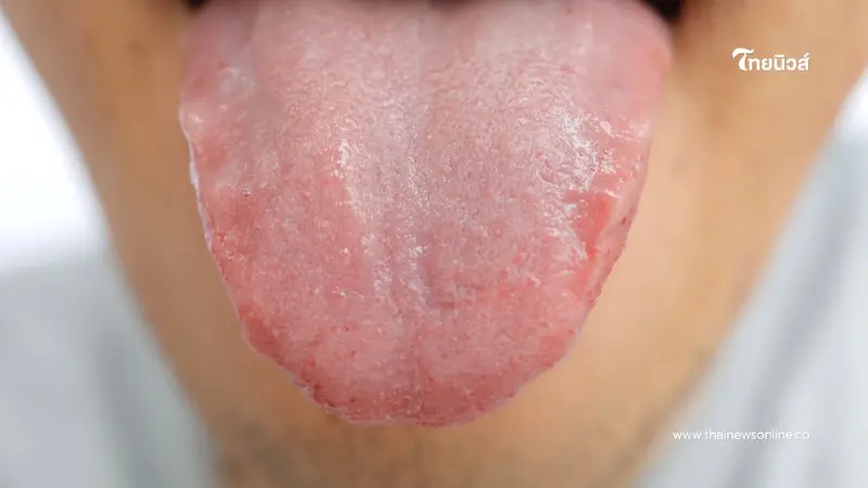 ลิ้นบอกสุขภาพ เช็กได้ว่าร่างกายกำลังส่งสัญญาณเตือนอะไรหรือไม่ ลิ้นบอกสุขภาพ เช็กได้ว่าร่างกายกำลังส่งสัญญาณเตือนอะไรหรือไม่