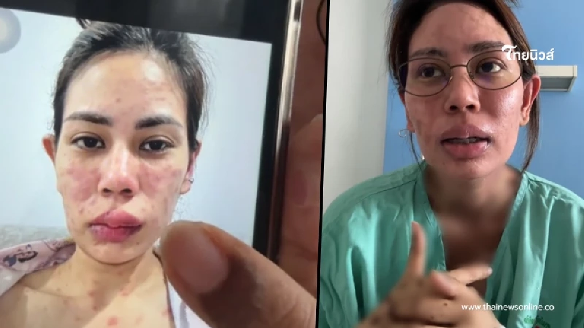 สาวเล่าอุทาหรณ์ ผื่นขึ้นหน้า ก่อนลามทั้งตัว รักษานานเป็นเดือน