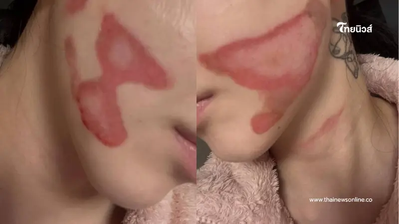 อดีตไอดอลคนดัง หน้าพังไฟไหม้ พีกกว่าคือคำพูดของผู้บริหารคลินิก