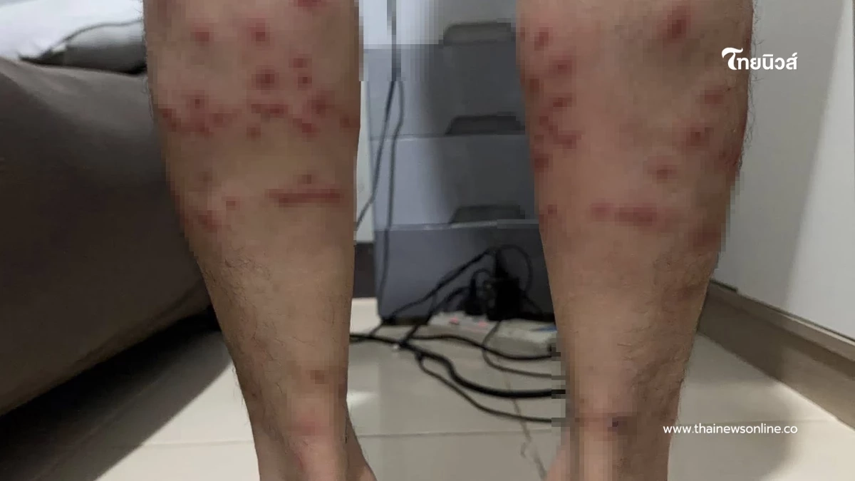 อุทาหรณ์นักวิ่ง เจอ "ตัวคุ่น" เล่นงาน คันทรมานกว่าที่คิด