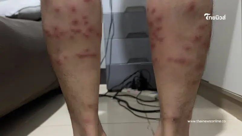 อุทาหรณ์นักวิ่ง เจอ "ตัวคุ่น" เล่นงาน คันทรมานกว่าที่คิด