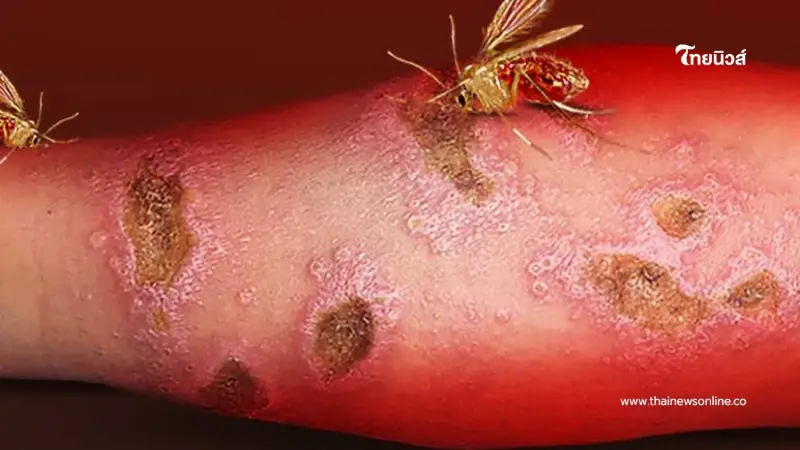 ระวัง "โรคลิชมาเนีย" ภัยร้ายจากริ้นฝอยทราย เช็กวิธีป้องกัน