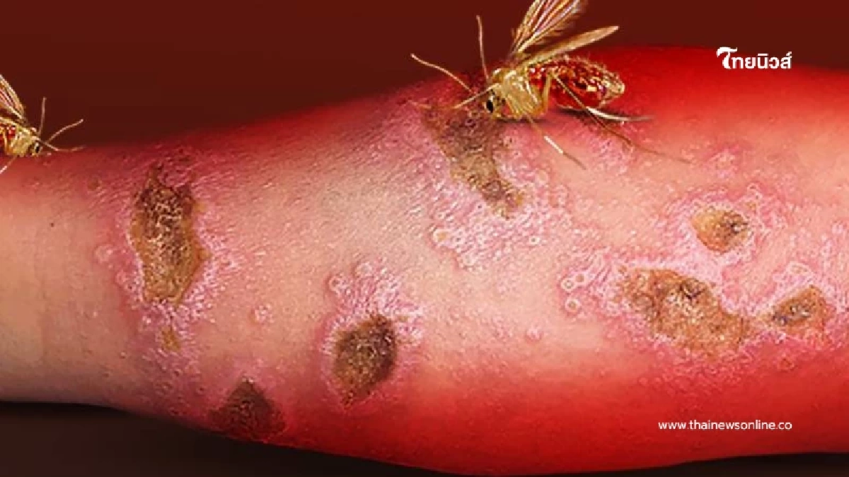 ระวัง "โรคลิชมาเนีย" ภัยร้ายจากริ้นฝอยทราย เช็กวิธีป้องกัน ระวัง "โรคลิชมาเนีย" ภัยร้ายจากริ้นฝอยทราย เช็กวิธีป้องกัน