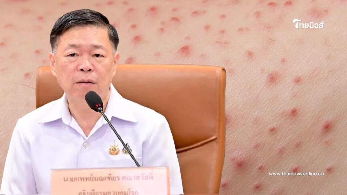 เตือน ติด "อีสุกอีใส" สะสมนับหมื่นแล้ว ตกใจ ช่วงอายุที่เป็นมากสุด