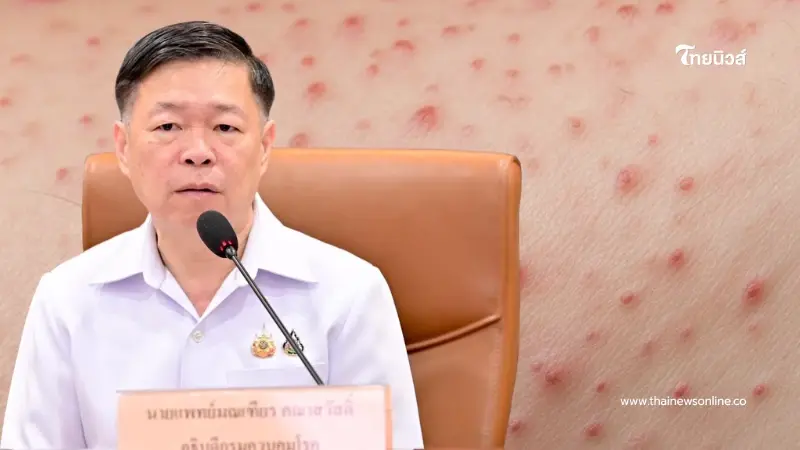 เตือน ติด "อีสุกอีใส" สะสมนับหมื่นแล้ว ตกใจ ช่วงอายุที่เป็นมากสุด เตือน ติด "อีสุกอีใส" สะสมนับหมื่นแล้ว ตกใจ ช่วงอายุที่เป็นมากสุด
