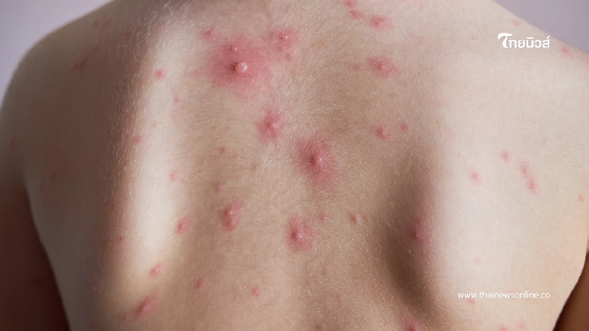 ยอดพุ่งหมื่นราย! สุกใสระบาดหนัก เด็กเล็กเสี่ยงสูง เช็กอาการด่วน