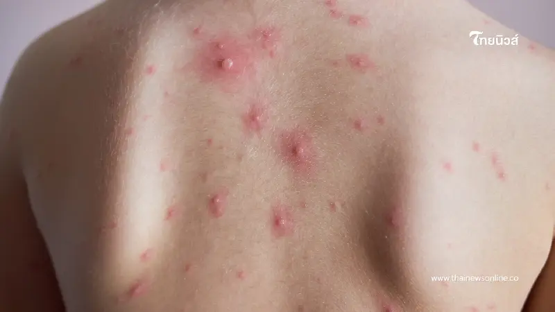 ยอดพุ่งหมื่นราย! สุกใสระบาดหนัก เด็กเล็กเสี่ยงสูง เช็กอาการด่วน