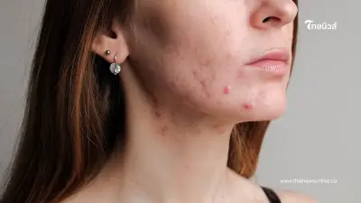 ผู้หญิงต้องรู้ 7 สัญญาณเตือน PCOS ภัยเงียบผู้หญิงที่ห้ามมองข้าม