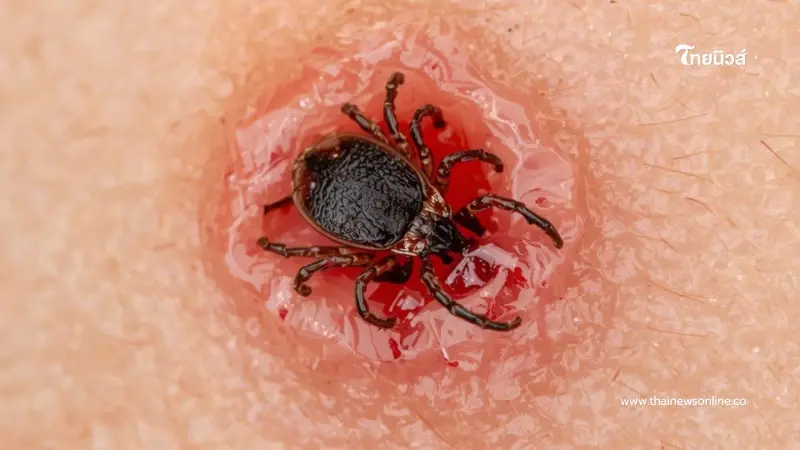 เช็ก ภัยใกล้ตัวจากเห็บกัด พบไวรัส SFTS ในไทย เสี่ยงสมองอักเสบ เช็ก ภัยใกล้ตัวจากเห็บกัด พบไวรัส SFTS ในไทย เสี่ยงสมองอักเสบ