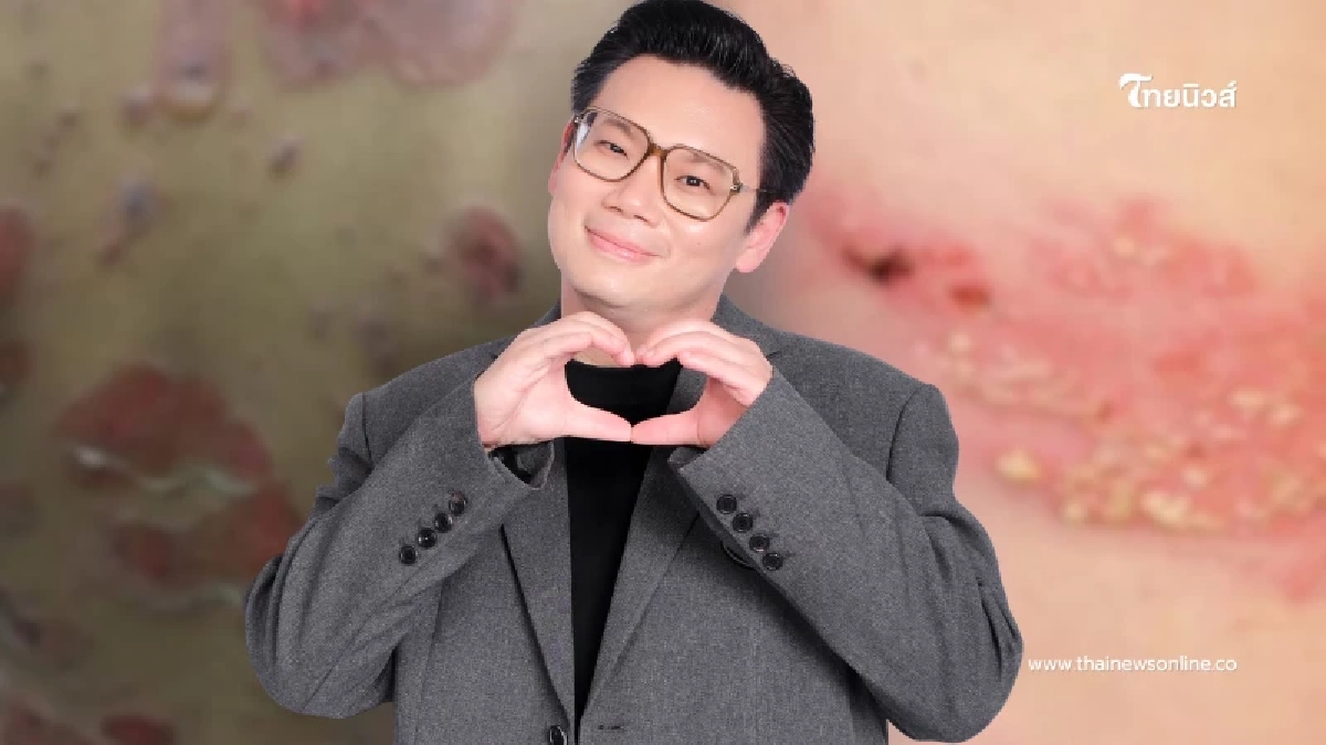 "อีสุกอีใส กับ งูสวัด" ต่างกันยังไง ถึงบางอ้อแล้ว หลายคนเข้าใจผิด