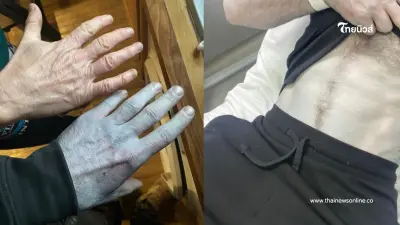 หนุ่มหลับยาว 14 ชม. ตื่นขึ้นตัวกลายเป็นสีฟ้า ผลตรวจออกมาทำตกใจ