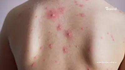 อีสุกอีใสระวังติดเชื้อรุนแรง เผย 5 วิธีดูแลที่ถูกวิธี ห้ามอาบน้ำต้มผัก