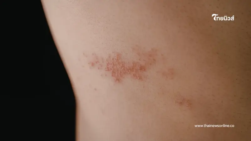 5 สัญญาณเตือน "โรคแพ้ภูมิตัวเอง" ที่ผู้หญิงห้ามละเลย ก่อนร่างกายพัง