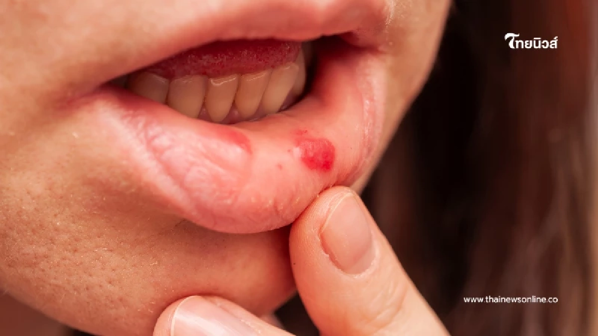 เจ็บปากซ้ำซากระวังภูมิพัง เช็ก 3 สัญญาณอันตรายและวิธีรักษาที่ต้นเหตุ เจ็บปากซ้ำซากระวังภูมิพัง เช็ก 3 สัญญาณอันตรายและวิธีรักษาที่ต้นเหตุ