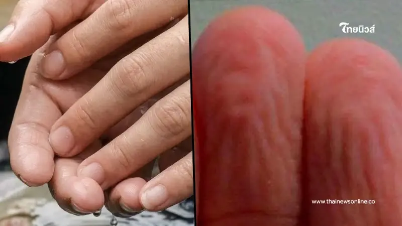 เกินคาด "นิ้วเหี่ยวตอนโดนน้ำ" เปิดสาเหตุแท้จริง ที่คนเข้าใจผิด เกินคาด "นิ้วเหี่ยวตอนโดนน้ำ" เปิดสาเหตุแท้จริง ที่คนเข้าใจผิด