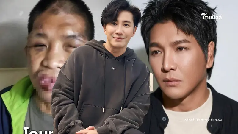 "หนุ่ม กรรชัย" โพสต์แล้ว น้องฟ้าได้ชีวิตใหม่ หลังผ่าตัด 11 ครั้ง