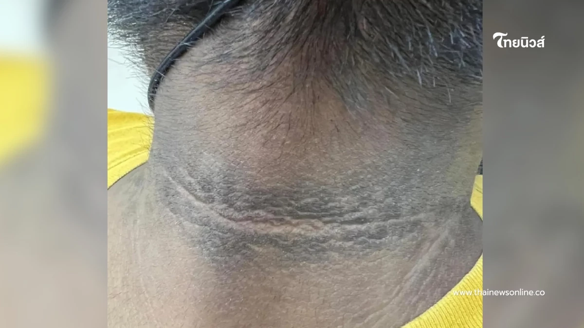 ถึงว่า "คอคาร์บอน" ขัดไม่ออก หมอเผยสัญญาณเสี่ยง ต้องแก้ให้ตรงจุด