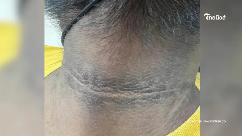 ถึงว่า "คอคาร์บอน" ขัดไม่ออก หมอเผยสัญญาณเสี่ยง ต้องแก้ให้ตรงจุด