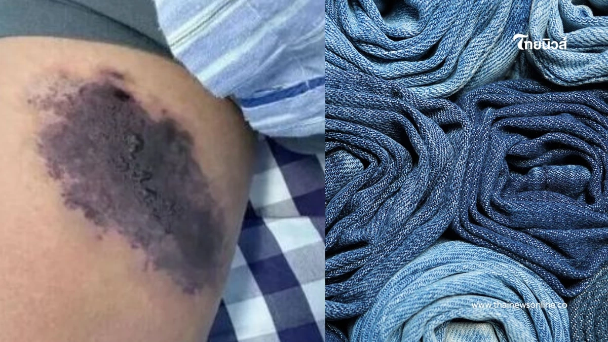 หนุ่มรื้อกางเกงเก่ามาใส่ สุดท้ายติดเชื้อ ก่อนเจอตัวการน่าตกใจ หนุ่มรื้อกางเกงเก่ามาใส่ สุดท้ายติดเชื้อ ก่อนเจอตัวการน่าตกใจ