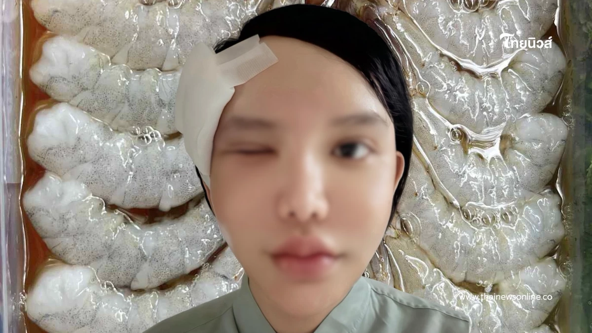 ใครชอบกินต้องระวัง กุ้งแช่น้ำปลาทำพิษ ต้องผ่าตัด นอนแอดมิท 10 วัน