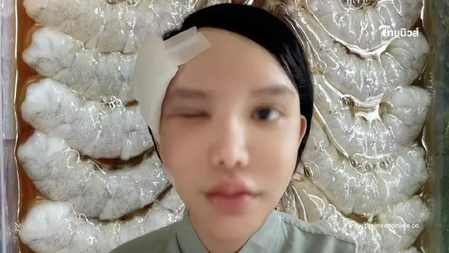 ใครชอบกินต้องระวัง กุ้งแช่น้ำปลาทำพิษ ต้องผ่าตัด นอนแอดมิท 10 วัน