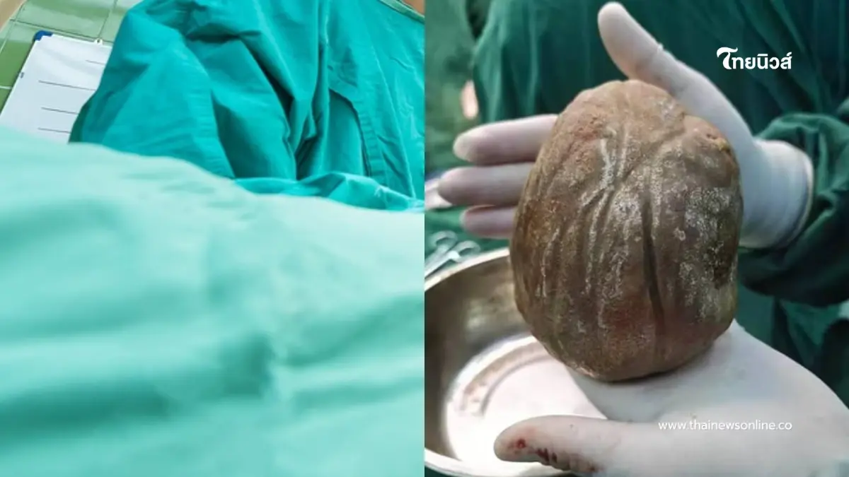 หมอยังตกใจ ผ่าก้อนปริศนาออกจากตัวคนไข้วัย 56 ก่อนรู้ว่าคืออะไร