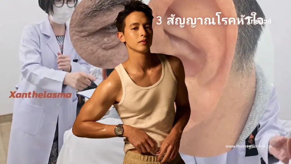 หมอฝากถึง "เจมส์ จิรายุ" รีบเช็ก 3 จุดบนร่างกาย หลังคอเลสเตอรอลสูง หมอฝากถึง "เจมส์ จิรายุ" รีบเช็ก 3 จุดบนร่างกาย หลังคอเลสเตอรอลสูง