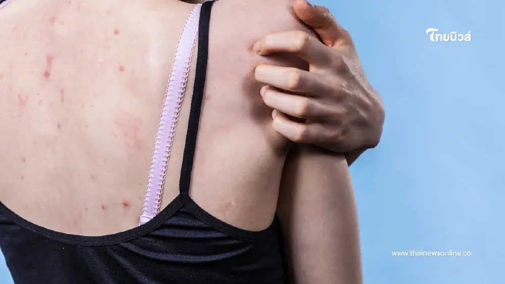 ผู้เชี่ยวชาญเผย สิวแต่ละจุดอาจกำลังเตือนปัญหาสุขภาพ