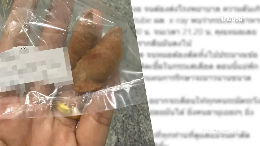 ลูกเล่านาทีชีวิต แม่กลืนเม็ดกระท้อน กระเพาะทะลุ - ลำไส้ขาด ต้องผ่าตัดด่วน ลูกเล่านาทีชีวิต แม่กลืนเม็ดกระท้อน กระเพาะทะลุ - ลำไส้ขาด ต้องผ่าตัดด่วน