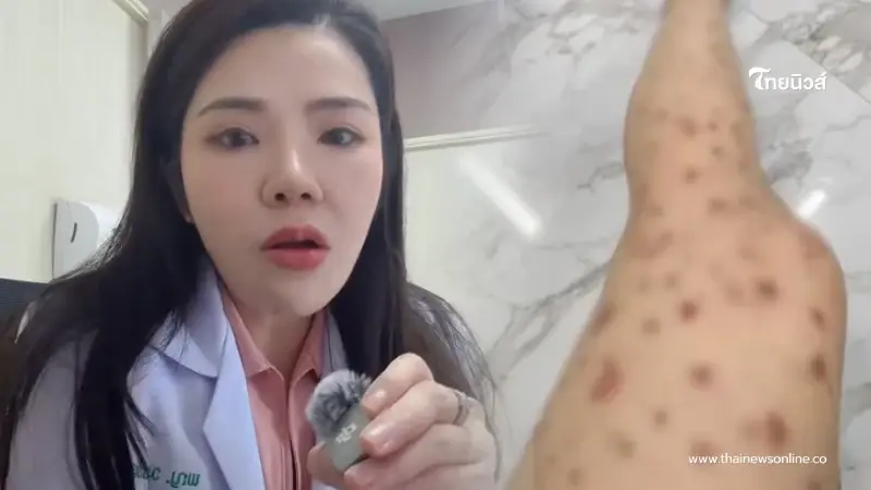 หมอเมย์ เผยสาเหตุแท้จริง นายจ้างติดวัณโรคปอด หลังรู้แม่บ้านป่วย HIV หมอเมย์ เผยสาเหตุแท้จริง นายจ้างติดวัณโรคปอด หลังรู้แม่บ้านป่วย HIV